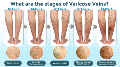 GFOUK® VenaRestore MicroNeedle Vein Repair Patch 🇨🇦
